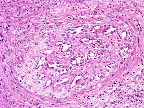 1E6 Cryptococcus (Case 1) H&E 2