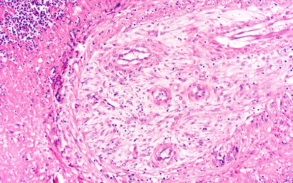 1E7 Cryptococcus (Case 1) H&E 3