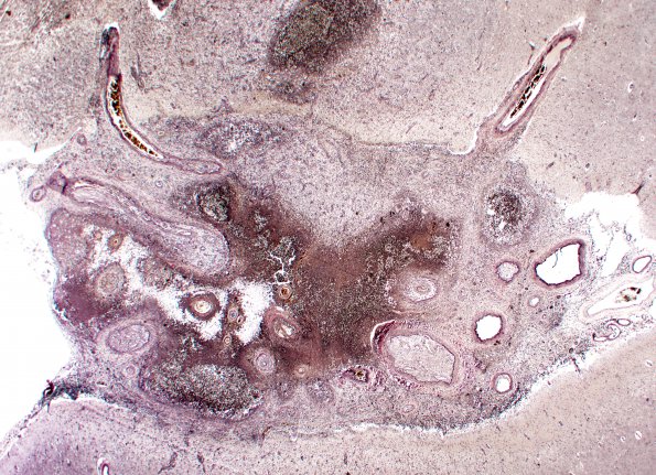 1F2 Cryptococcus (Case 1) VVG 1A