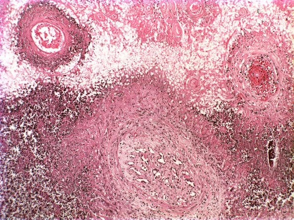 1F4 Cryptococcus (Case 1) 7 arteritis VVG 2