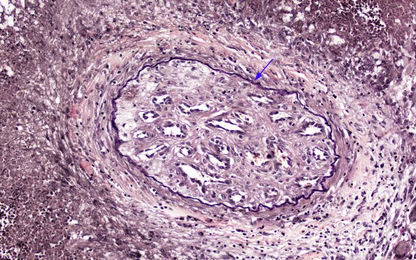 1F5 Cryptococcus (Case 1) VVG 2 copy