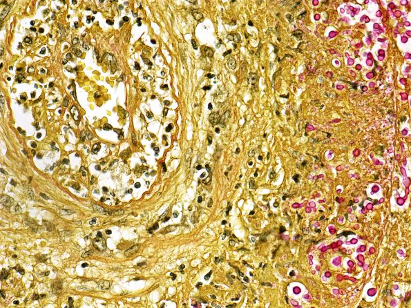 1G1 Cryptococcus (Case 1) Mucicarmine 2