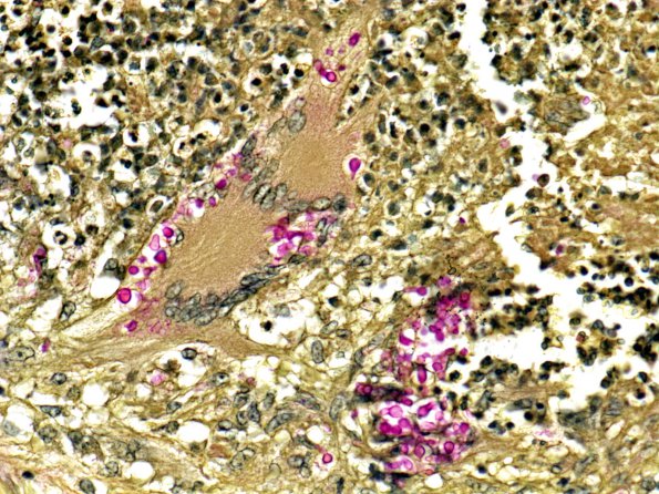 1G2 Cryptococcus (Case 1) Mucicarmine 1