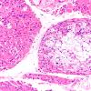 1A2 Cryptococcus, disseminated in muscle (Case 1) H&E 20X