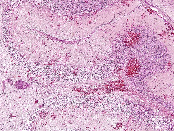 1A2 Fungi, Quail brain Dactylaria H&E 1B