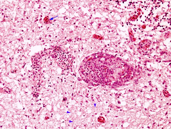 1A3 Fungus, Quail brain Dactylaria 1 copy