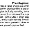 0A Phaeohyphomycosis text