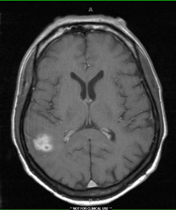 1A1 Fungus (Case 1) T1 W - Copy