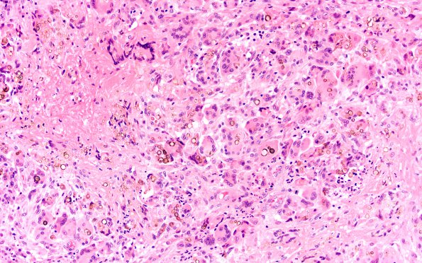 1B1 Abscess, Dematiaceous (pigmented) Fungus (Case 1) H&E 6