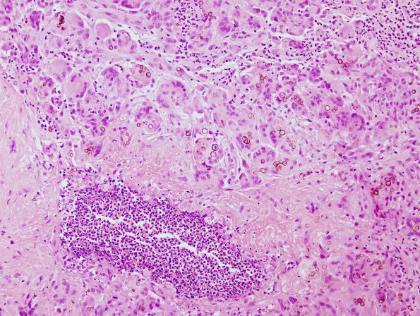 1B2 Abscess, Dematiaceous (pigmented) Fungus (Case 1) H&E 4