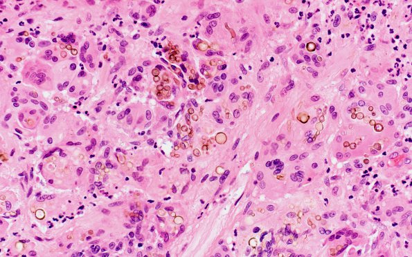 1B3 Abscess, Dematiaceous (pigmented) Fungus (Case 1) H&E 2