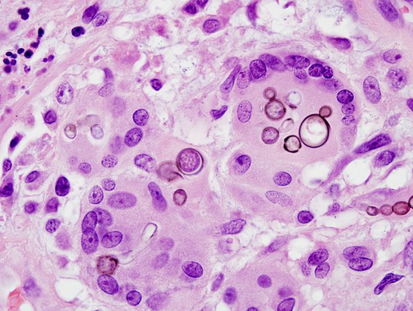 1B5 Abscess, Dematiaceous (pigmented) Fungus (Case 1) H&E 5