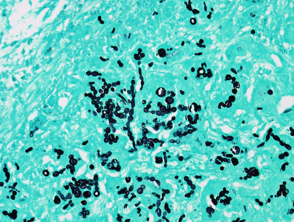 1C1 Abscess, Dematiaceous (pigmented) Fungus (Case 1) GMS 2jpg