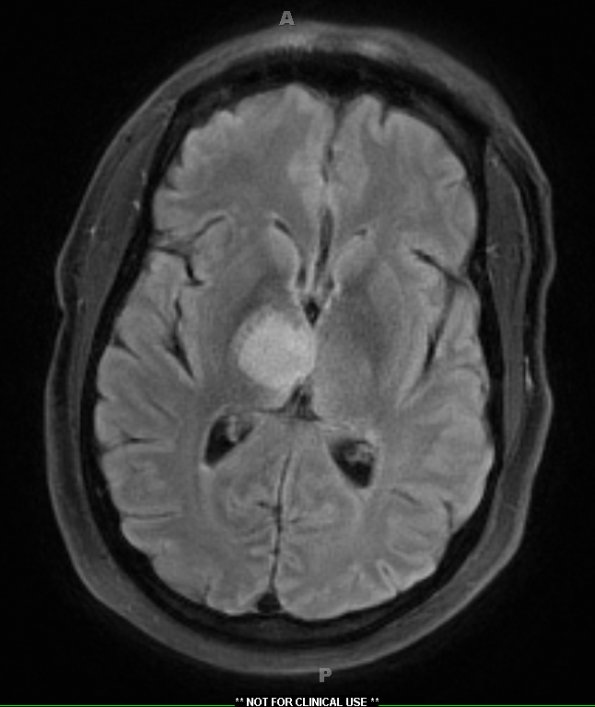 2A1 Pigmented fungus (Case 2) TIRM - Copy