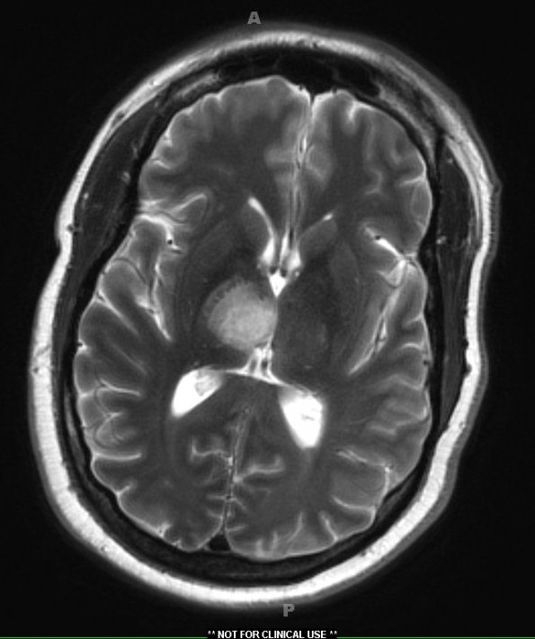 2A2 Pigmented fungus (Case 2) T2 W 1 - Copy