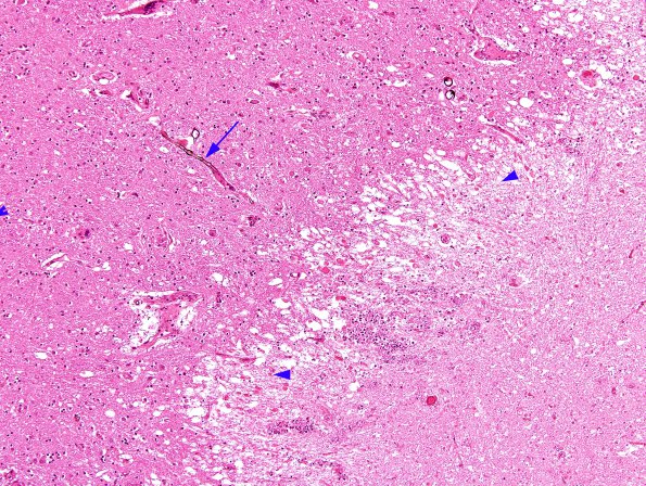 2D3 Fungus, pigmented (Case 2) N4 H&E 1 copy