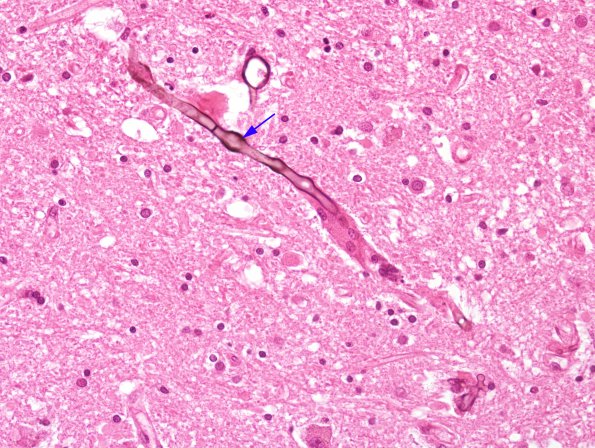 2D4 Fungus, pigmented (Case 2) N4 H&E 2 copy