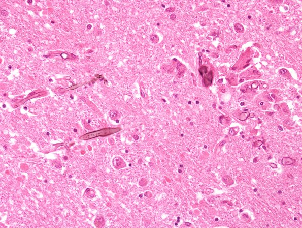 2D6 Fungus, pigmented (Case 2) N4 H&E 11