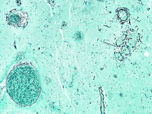 2E1 Fungus, pigmented (Case 2) N4 GMS 4