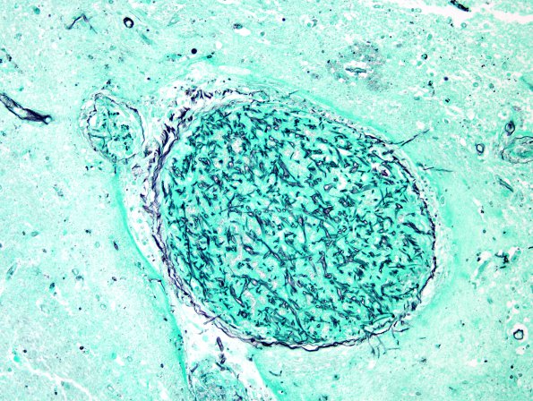 2E2 Fungus, pigmented (Case 2) N4 GMS