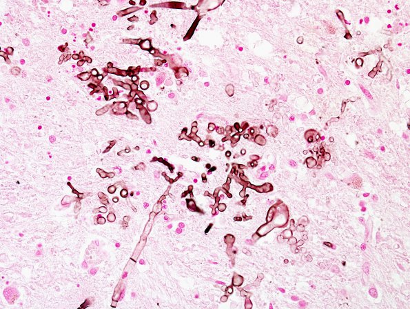 2E4 Fungus, pigmented (Case 2) Fontana Masson 3