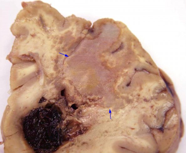 3A1 Fungus, pigmented (Bipolaris species, AANP 2012- Case 7) Thanks C Fuller MD copy A