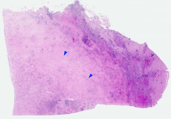 3B1 Fungus, pigmented (Bipolaris species, AANP 2012- Case 7) H&E whole mount copy