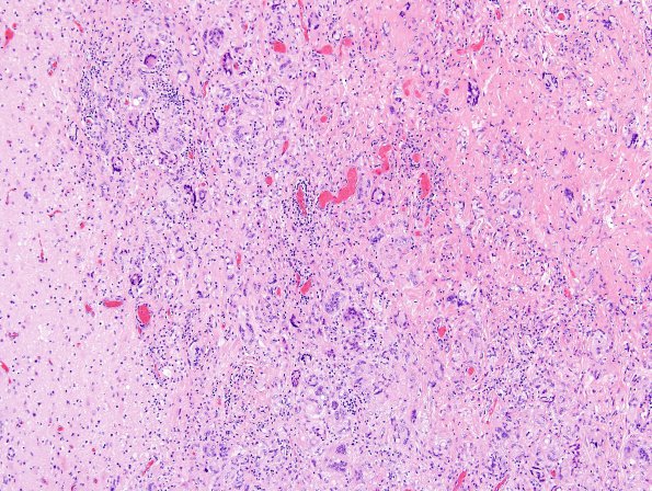 3B2 Fungus, pigmented (Bipolaris species, AANP 2012- Case 7) H&E 1