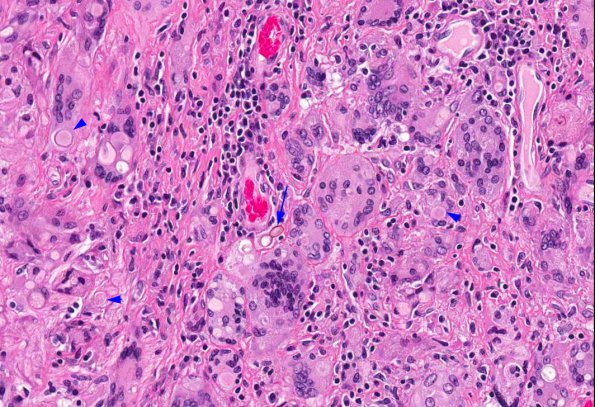 3C2 Fungus, pigmented (Bipolaris species, AANP 2012- Case 7) H&E 15 copy A