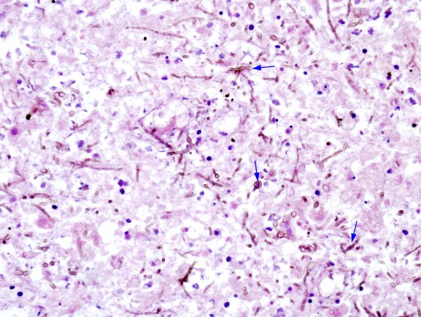 4A2 Chromogenic fungus (AANP 2006-4) 2 copy