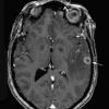 1A1 Abscess, Histoplasmosis (Case 1) T1 3D - Copy copy