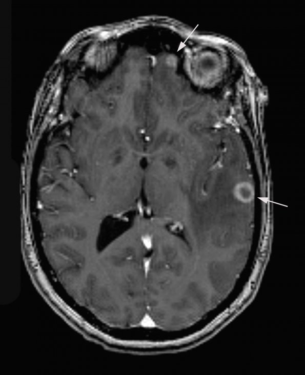 1A1 Abscess, Histoplasmosis (Case 1) T1 3D - Copy copy