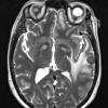 1A2 Abscess, Histoplasmosis (Case 1) T2 2 - Copy