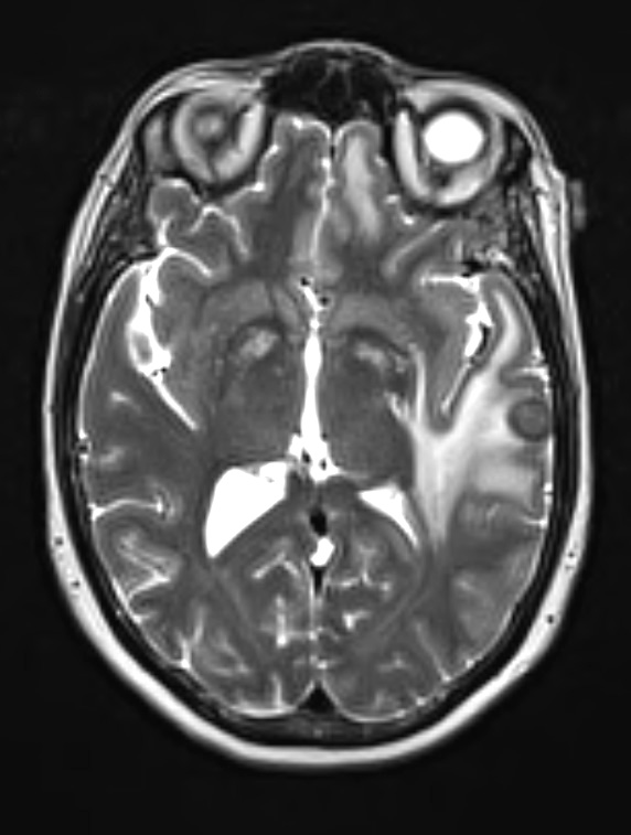 1A2 Abscess, Histoplasmosis (Case 1) T2 2 - Copy