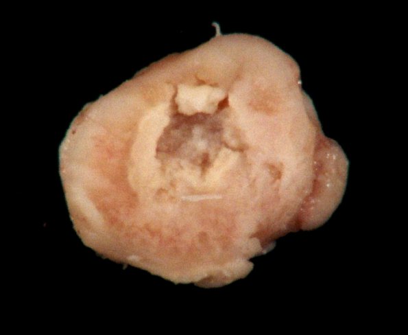 1B Abscess, Histoplasmosis (Case 1) Gross_1