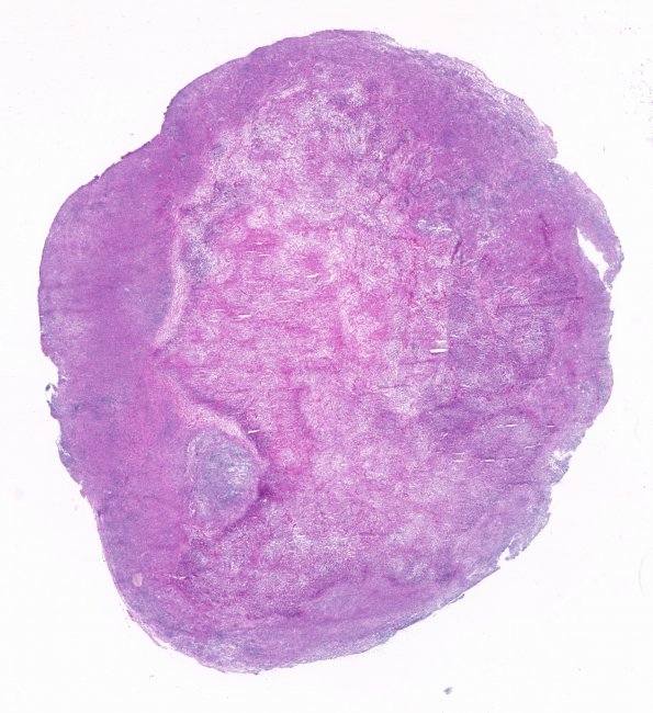 1C1 Abscess, Histoplasmosis (Case 1) H&E 1 (frozen section)