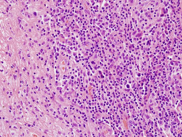 1C2 Abscess, Histoplasmosis (Case 1) H&E 9