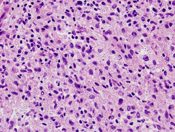 1C3 Abscess, Histoplasmosis (Case 1) H&E 12