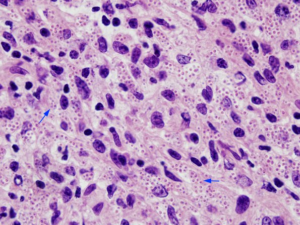 1C4 Abscess, Histoplasmosis (Case 1) H&E 13 copy