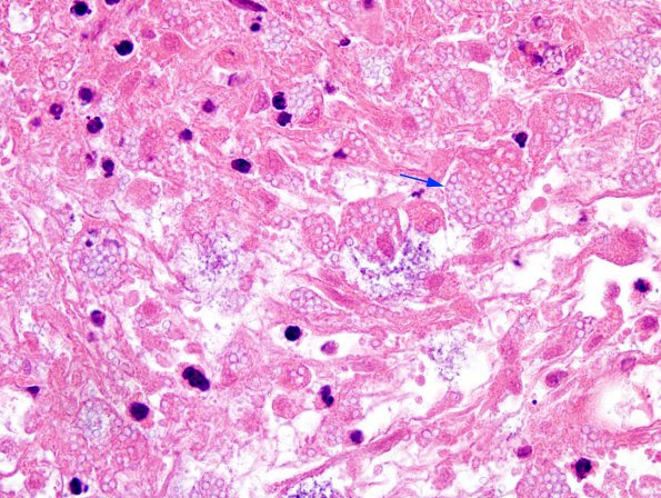 1C5 Abscess, Histoplasmosis (Case 1) H&E 3 copy