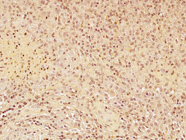 1D10 Abscess, Histoplasmosis (Case 1) Mucicarmine