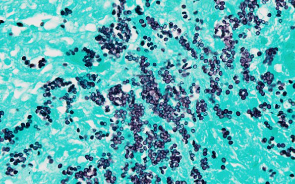 1D2 Abscess, Histoplasmosis (Case 1) GMS 9 Oil