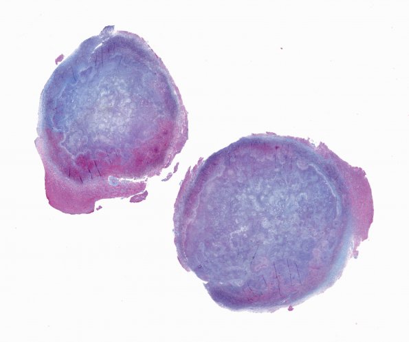 1D3 Abscess, Histoplasmosis (Case 1) Trichrome whole mount A