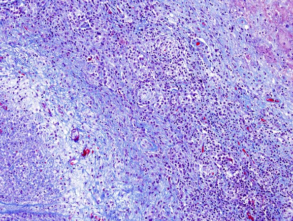 1D5 Abscess, Histoplasmosis (Case 1) Trichrome 6 A