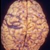 2A1 Histoplasmosis (Case 2) A4 copy copy