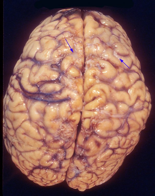 2A1 Histoplasmosis (Case 2) A4 copy copy