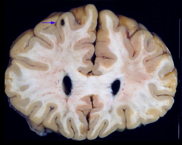 2A2 Histoplasmosis (Case 2) A4 copy