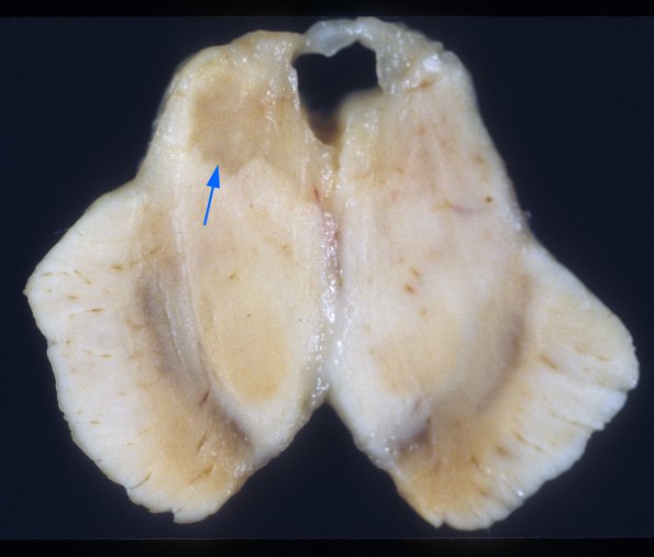 2A3 Histoplasmosis (Case 2) A1 copy