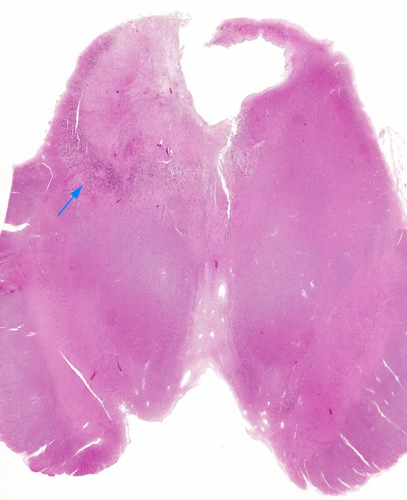 2B1 Histoplasmosis (Case 2) H&E 4 whole mount copy A