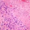 2B2 Histoplasmosis (Case 2) H&E 5